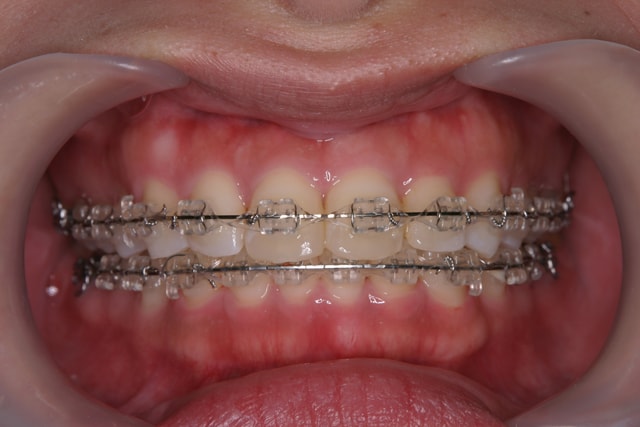 すべての歯に装置をつける全顎矯正の装置