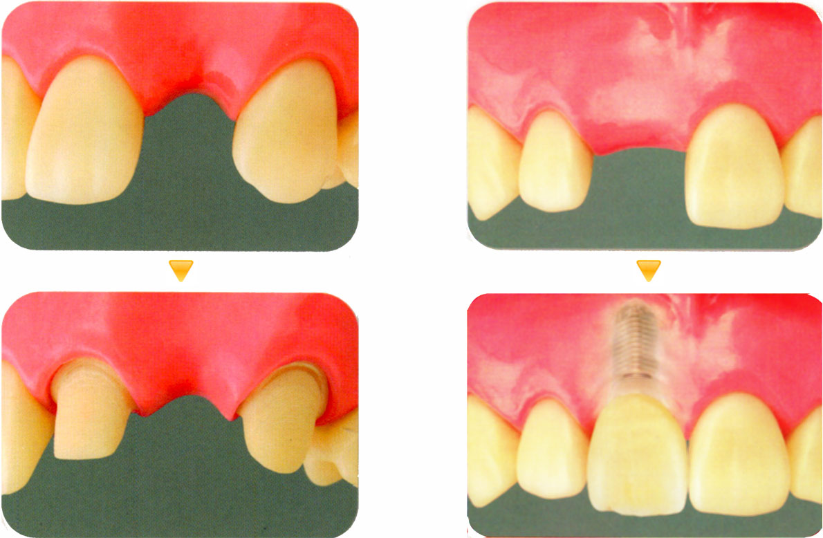 保険診療のブリッジ治療では歯を削る必要があり（左）、自由診療のインプラント治療では両隣の歯を削る必要がありません（右）