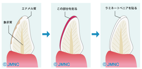 ラミネートベニヤ治療方法