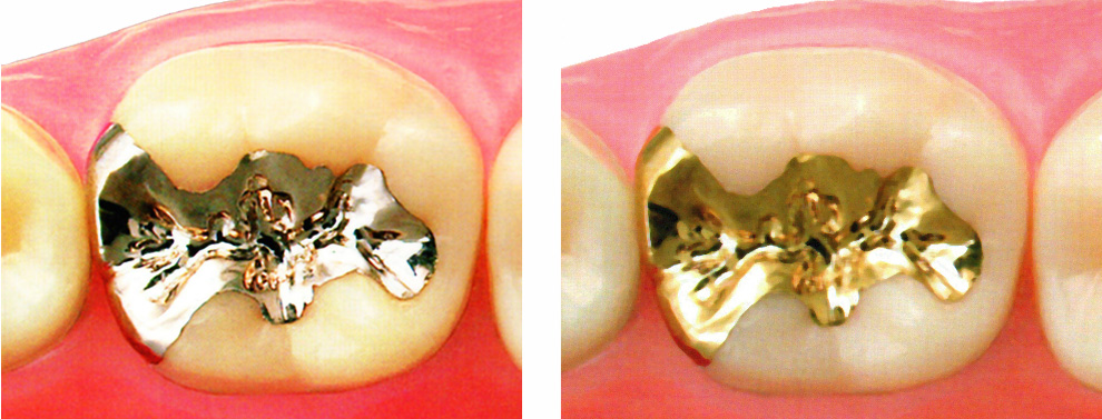 保険診療の銀歯（左）と虫歯になりづらい金歯（自由診療）