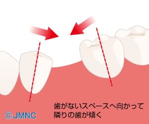 隙間に歯が倒れるイラスト2