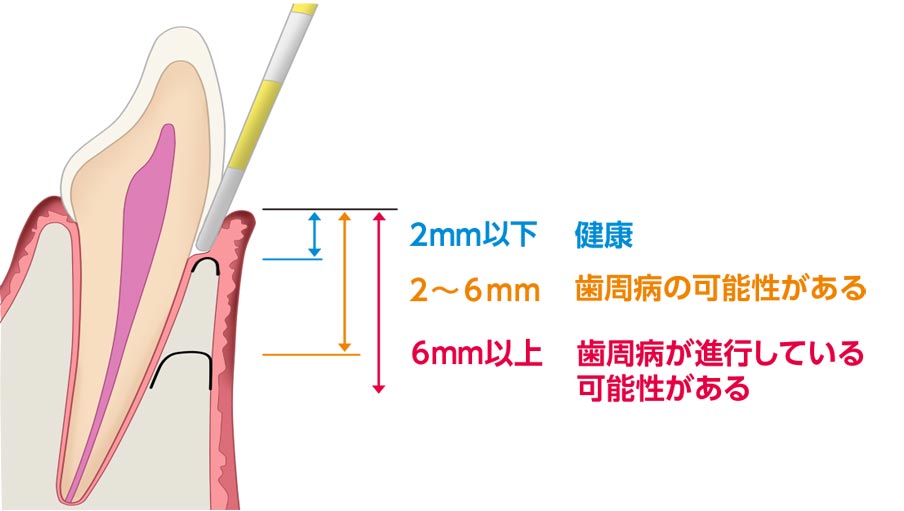 歯周ポケットの深さによる歯周病進行度の違い