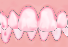 歯垢の染め出し
