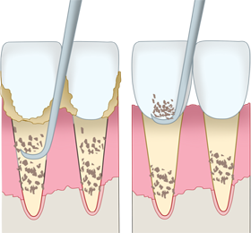 スケーラーによる歯石除去