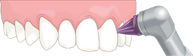ブラシによる歯面研磨