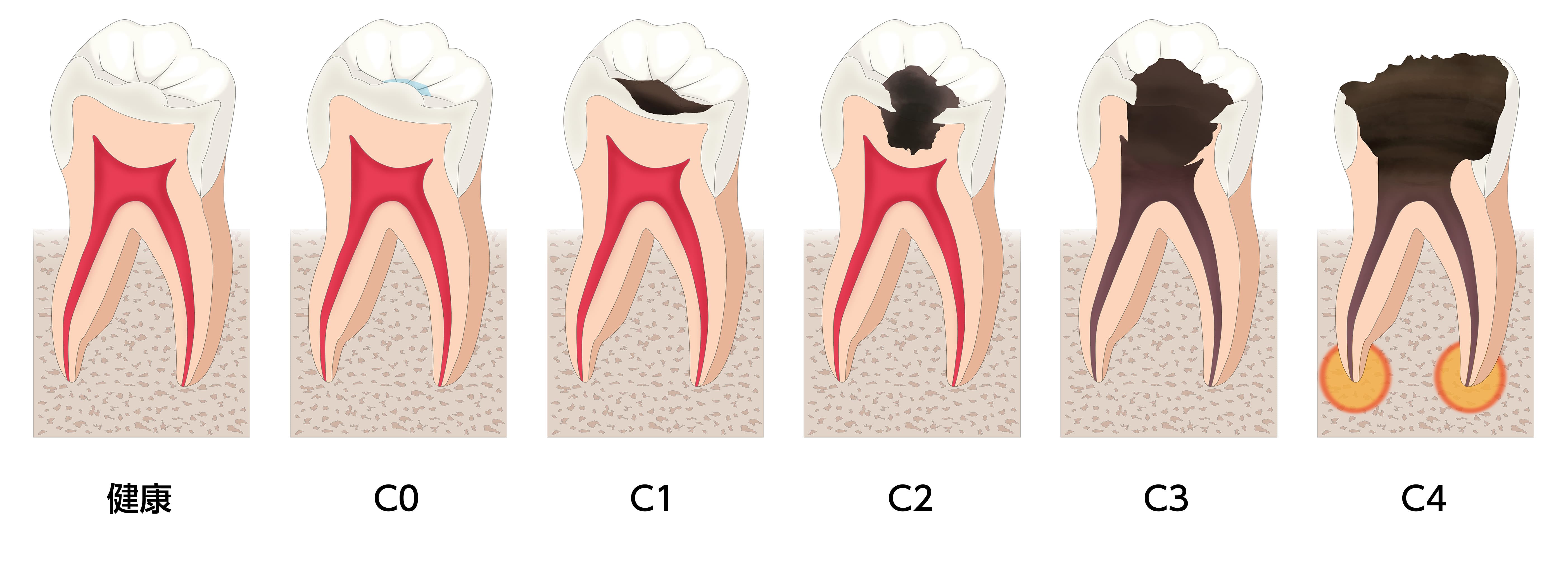 虫歯の進行度