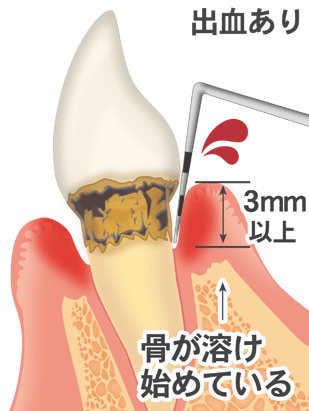 歯周ポケットが3mm以上で出血している歯茎のイラスト