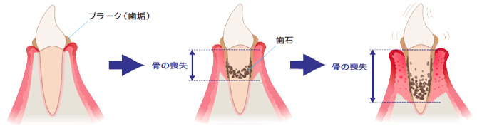 歯周病の進行度