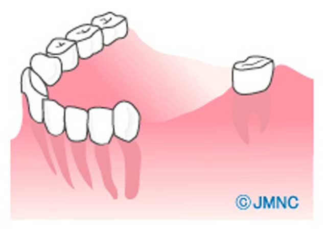 親知らずを利用したブリッジ治療