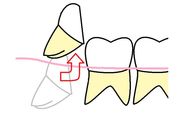 親知らずを抜く図