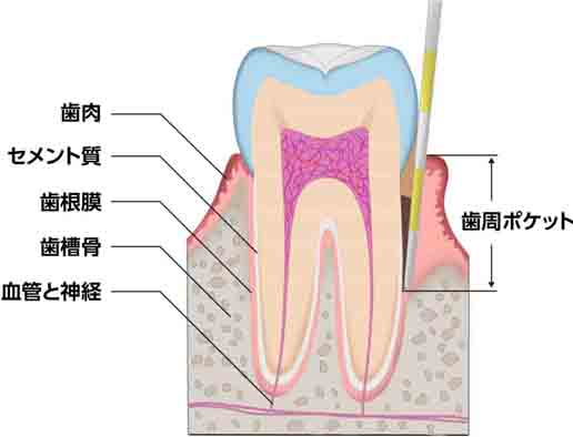 歯周病の溜まりやすい歯周病ポケット